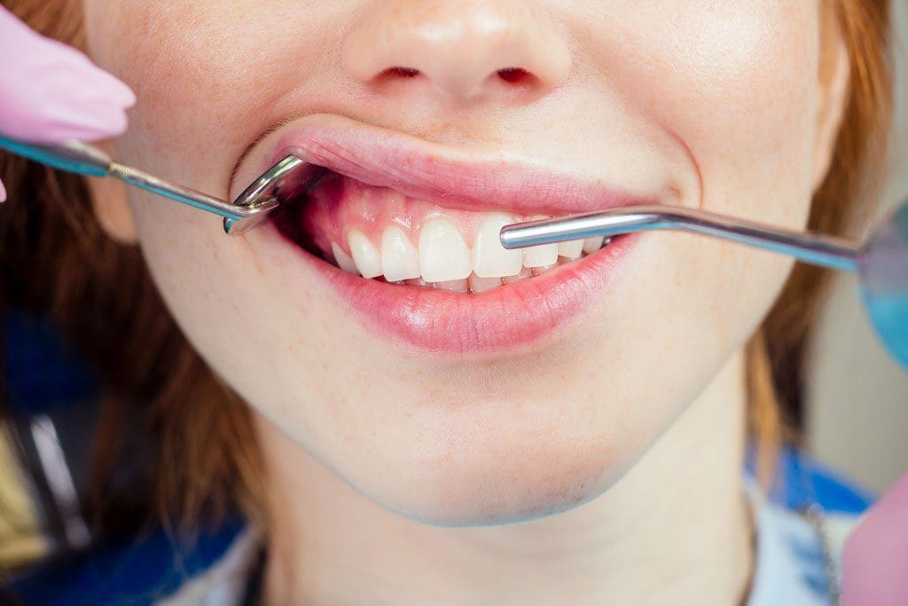 Hollywood Smile 6 Image link