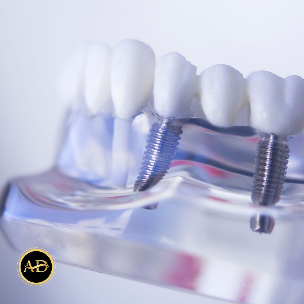 Traitement Implantaire En 1 Jour 20 implants dentaires en turquie maintenant 2