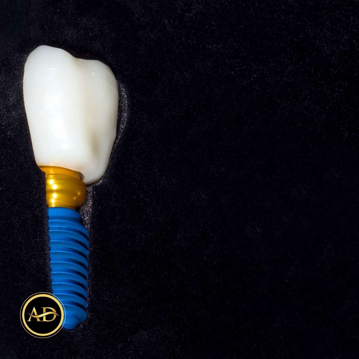 Traitement Implantaire En 1 Jour 19 implants dentaires en turquie maintenant