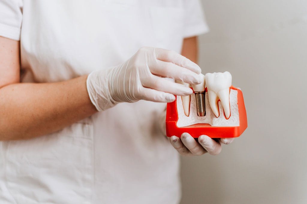 Traitement Implantaire En 1 Jour 13 implants dentaires en une journee a antalya