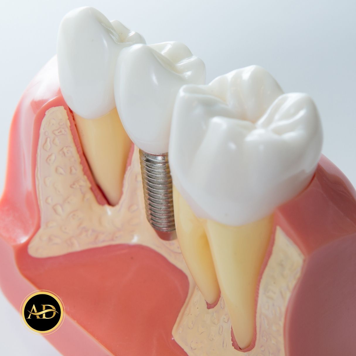 Traitement Implantaire En 1 Jour 17 implants dentaires en une journee en turquie 2