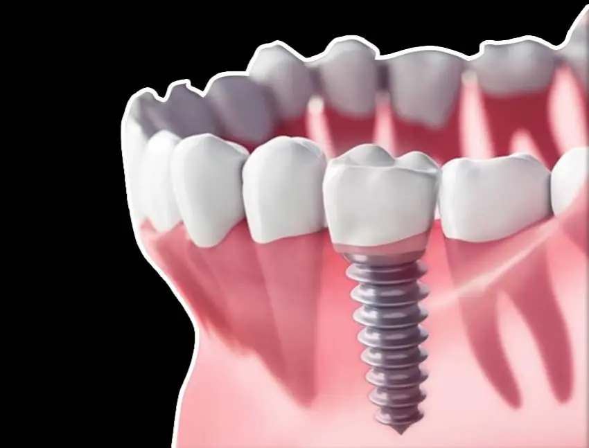 RU Landing 2027 11 Immediate Dental Implants