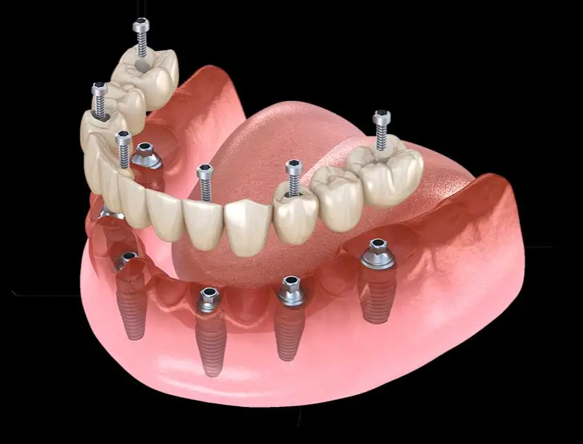 RU Landing 2027 10 All On 6 dental implants