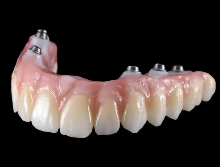 RU Landing 2027 14 Cement-Retained Crowns on Implants