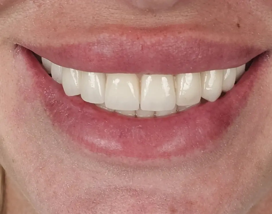 RU Landing 2027 13 Zirconia Teeth (Zirconium Dioxide)