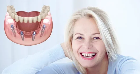Implantat Behandlung an einem Tag 1 Zahnimplantat in 1 Tag in der Türkei