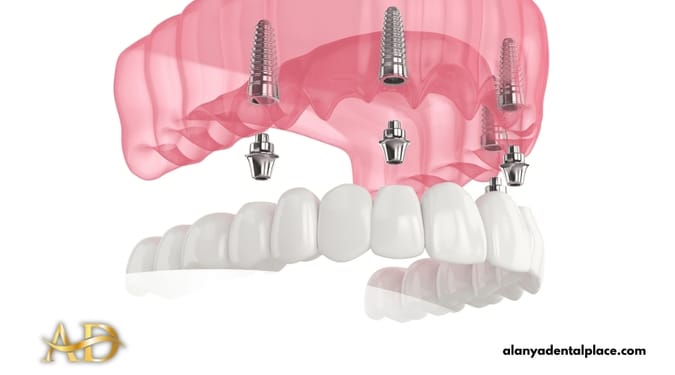 All-on-4 Dental Implants 1 Image link