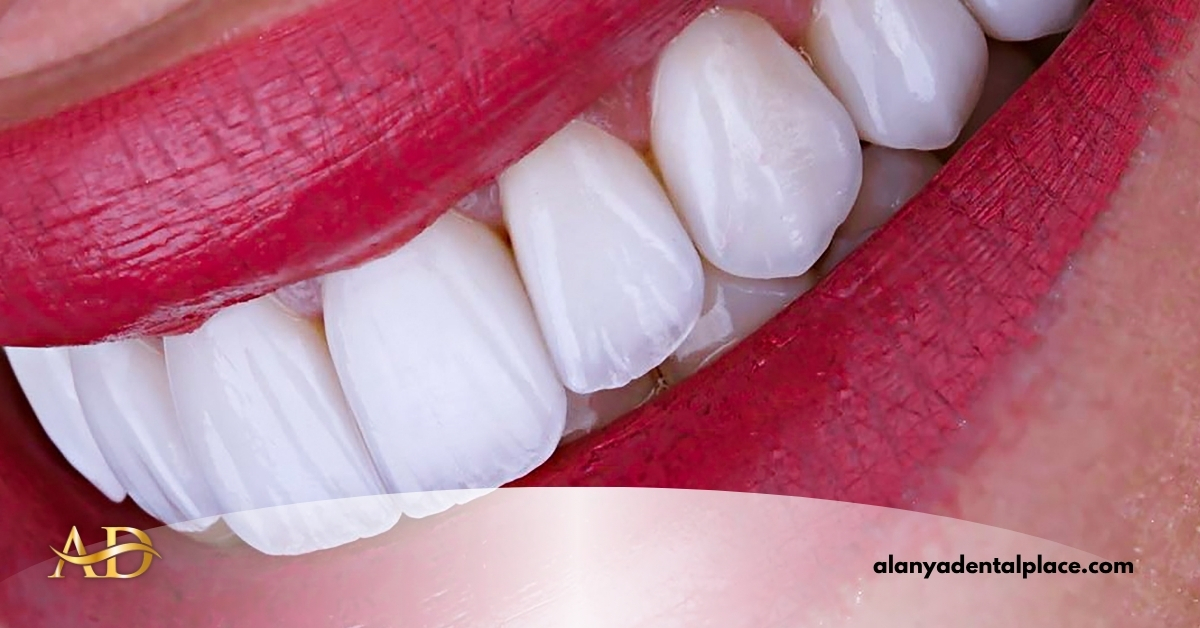 E-Max Crowns 1 Image link