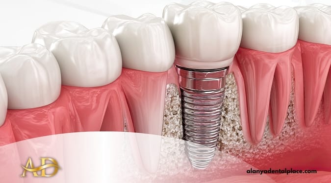Implants dentaires All-on-6 1 Image link