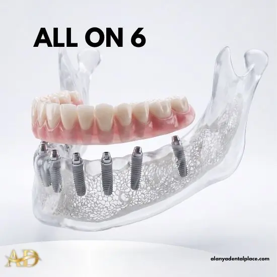 Лікування зубів 3 Зубні імплантати All On 6
