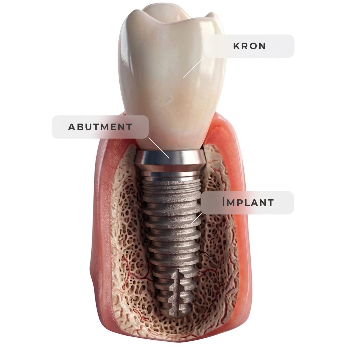 RU Landing 2027 2 dental implants turkey