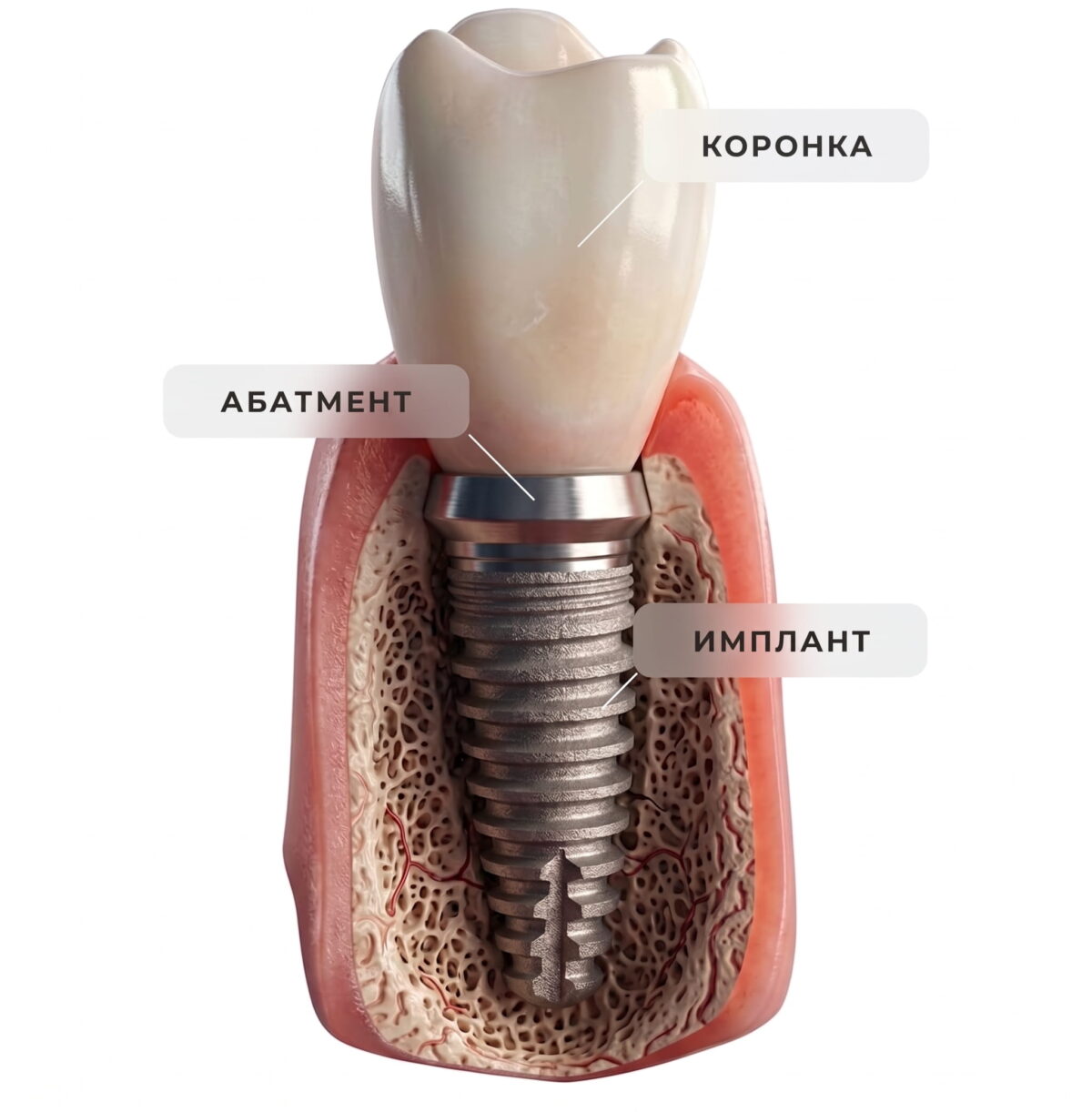 RU Landing 2027 2 dental implants turkey