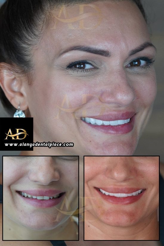 E-Max Crowns 28 dental veneers before after