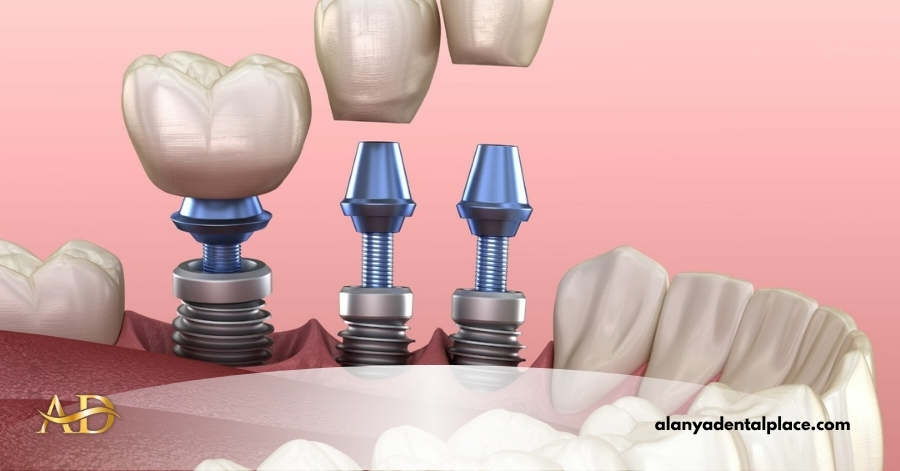 Diş İmplant Tedavisi 1 diş implantı