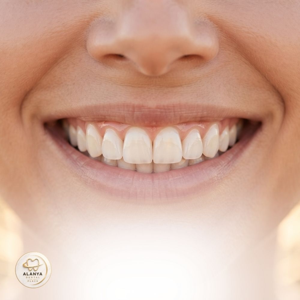 Hollywood Gülüşü 2 hollywood smile turkiye