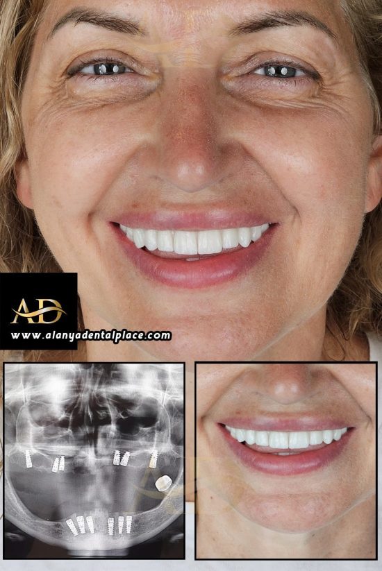 E-Max Crowns 29 implant before after 1
